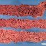 Familial adenomatous polyposis