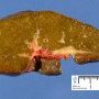 Cholestatic cirrhosis in extra-hepatic bile duct atresia