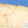 Mammary fibroadenoma