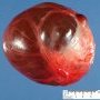 Ovarian hemorrhagic serous cystadenoma