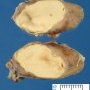 Nodal epidermoid cyst