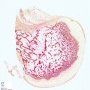 Osteochondroma