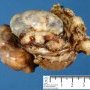 Peritoneal desmoplastic small round cell tumor