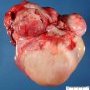 Intra-abdominal immature teratoma