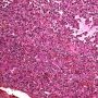 Macrophagic alveolitis