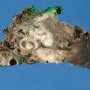 Pulmonary metastasis of an osteosarcoma