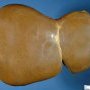 Cholestatic liver