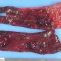 Intestinal intussusception in Peutz-Jeghers syndrome