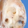testicular juvenile-type granulosa tumor