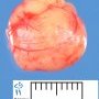 Schwannoma