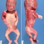 Thick neck in trisomy 21 (fetus 21 weeks)
