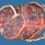 Triple pregnancy placenta