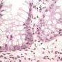 Inflammatory apoptotic cells in chronic colitis
