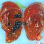 Cholelithiasis (Gallbladder lithiasis)