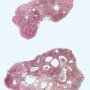 Colorectal juvenile polyp