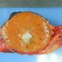 Renal oncocytoma
