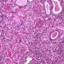 WT1-associated diffuse mesangial sclerosis