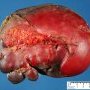 Spleen