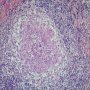 Suppurative epithelioid granuloma in familial granulomatous disease (...)