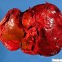 Hepatic ischemia in a liver allograft