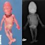 Microcephaly, fetal immotility sequence