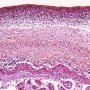 Acute chorioamnionitis