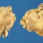 Fat (adipose tissue)