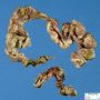Neonatal necrotizing enterocolitis