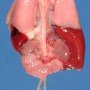Horseshoe kidney (Fetus, 20 weeks)
