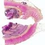 Colonic stenosis in Crohn disease