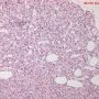 Infantile hemangioma