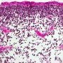 Embryonal botryoid rhabdomyosarcoma of the rhinopharynx