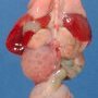 Unilateral renal agenesis, rectovesical fisula, anorectal atresia