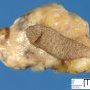 Pilomatrixoma