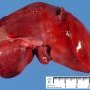 Hepatic deformation