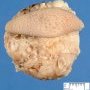 Lower limb lipoma