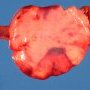 Mesenteric lipoma