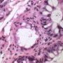 Colonic GVH