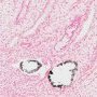 Renal tubular calcifications