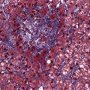 Hepatic granuloma (Etiology unknown)