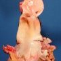 Aortic dissection in Marfan disease
