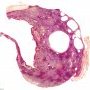 Hepatic mesothelial cysts