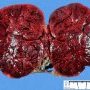 Epiploic hemorrhagic lipoma
