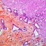 Ductal plate malformation (congenital hepatic fibrosis)