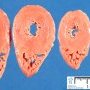Normal myocardium