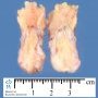 Perineal fibrolipoma. Macroscopy
