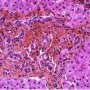 Portal fibrosis and biliary ductular proliferation in juvenile (...)