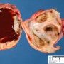 Ovarian endometriotic cyst