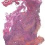 Cutaneous leishmaniasis