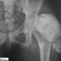 Tumoral calcinosis